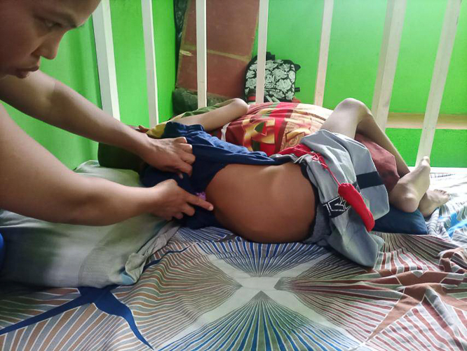During a home visit, Tzu Chi volunteers document Prince Galban’s struggles with Pott disease or tuberculosis of the spine. Symptoms include difficulty moving and large abscesses on his chest, back, and leg. 