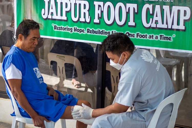 A volunteer prosthetic technician casts a patient’s leg for prosthesis.