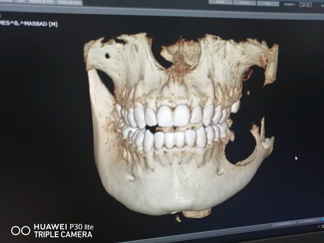A dentist found a mass near Cristopher Masbad’s left molars. The mass was benign but its fluid acted like acid and melted his left jaw bone./Photo courtesy of Cristopher Masbad