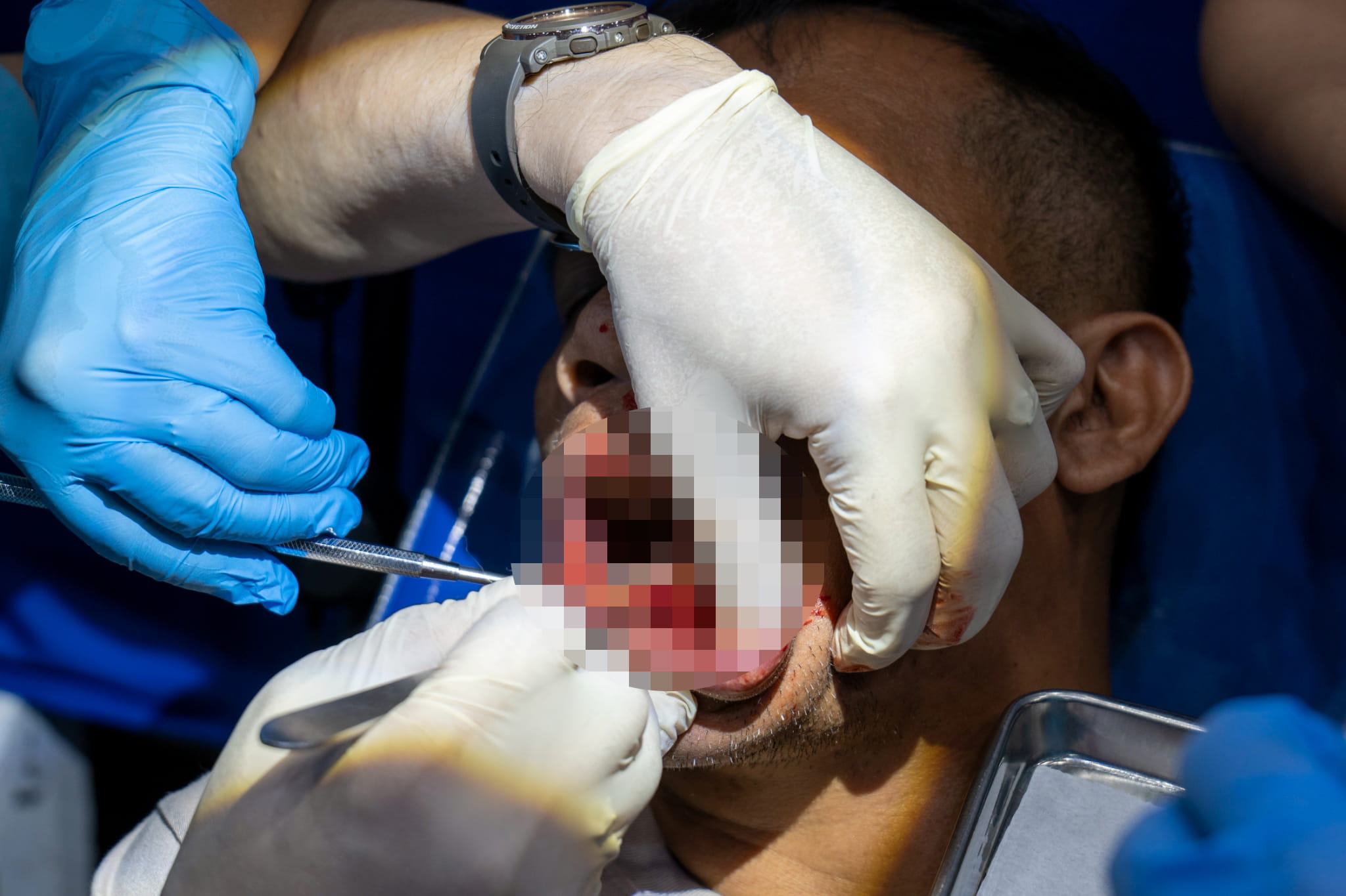 Beneficiary Roland Matias sought a tooth extraction but instead underwent a successful procedure to remove a growing periapical cyst in his gums.