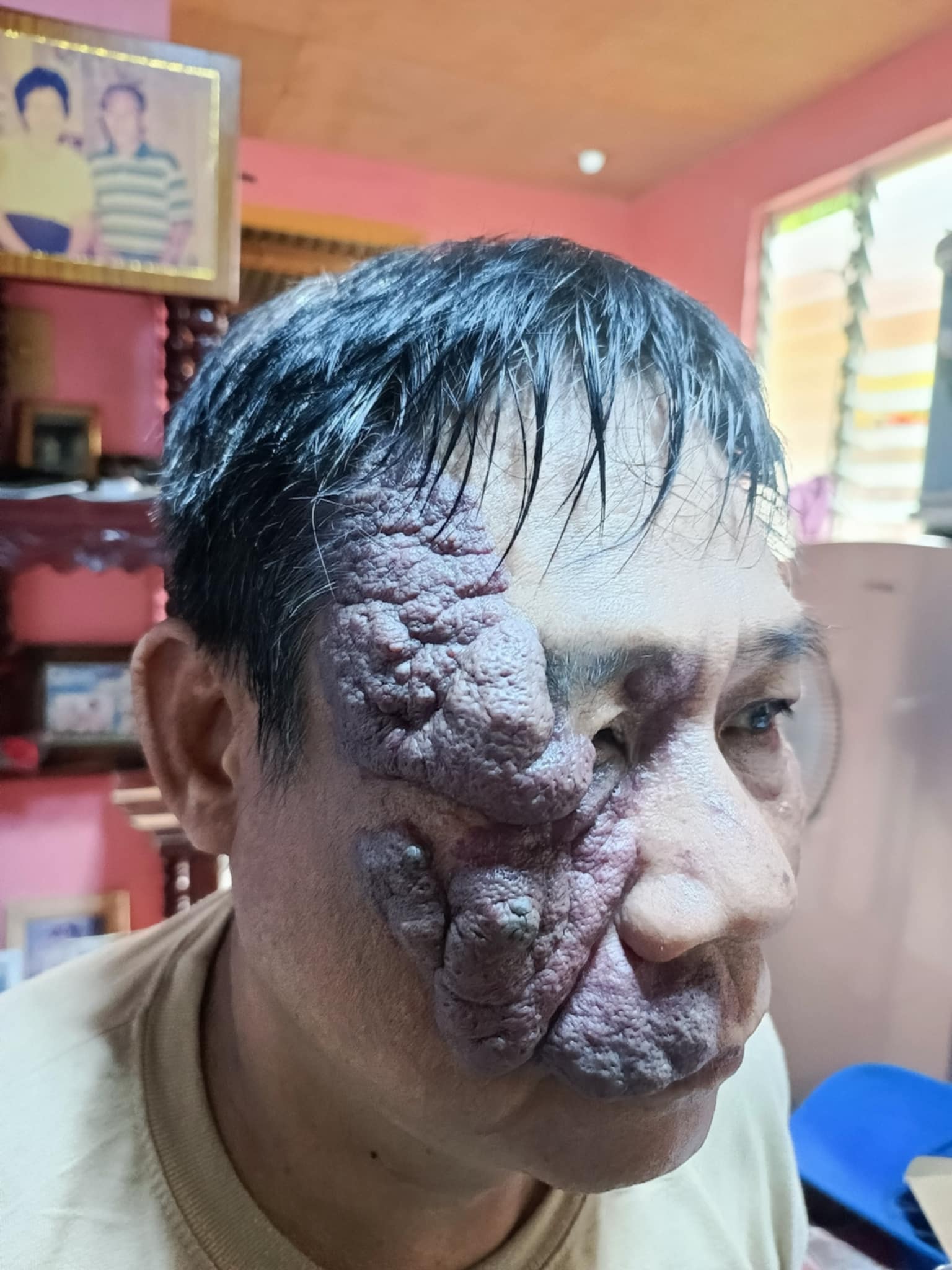 Alejandro Campaña Jr. was born with a hemangioma, a non-cancerous growth of blood vessels on his face. Most hemangiomas are harmless and tend to disappear in time, but his stayed and grew to the point that it encroached on his right eye, compromising his vision. 