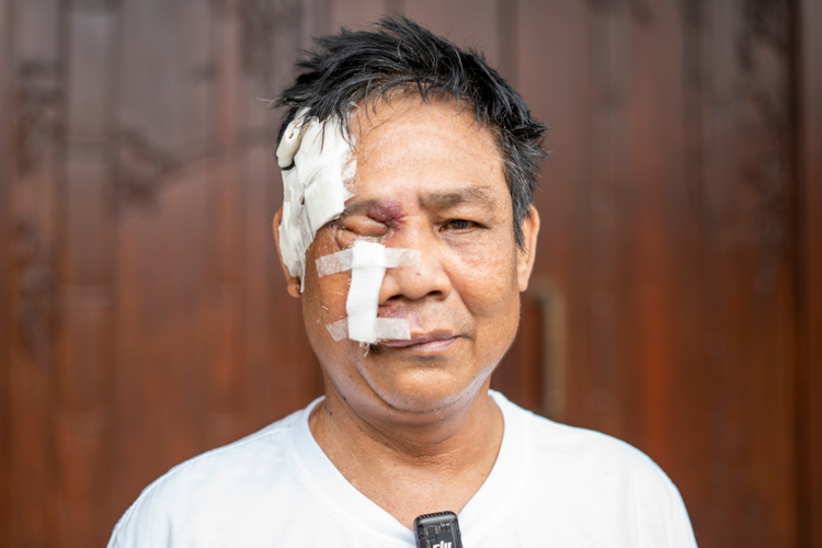 Through Tzu Chi Foundation’s medical assistance program, Alejandro Campaña Jr. underwent surgery to remove a large hemangioma on the right side of his face last November 23 at the Metropolitan Medical Center in Sta. Cruz, Manila. Though generally harmless, the growth has affected the vision on his right eye. 