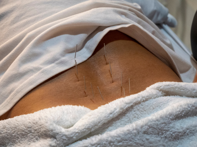 Dr. Chito Guzman (right) uses acupuncture on Arnel Arabejo. Fine needles are placed on key areas of the body to stimulate natural healing. 