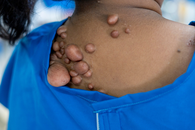 The last to undergo surgery was a lone case of neurofibromatosis, or the growth of benign tumors on different parts of the body. Volunteer doctors performed the “multiple excision of fibrolipomatous masses on the chest, bilateral upper extremities, right knee, and back” of patient Marissa Jaiben.