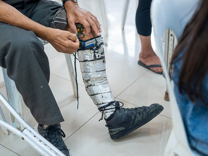 Derby Sebilo skillfully secured his self-made prosthesis using duct tape.
