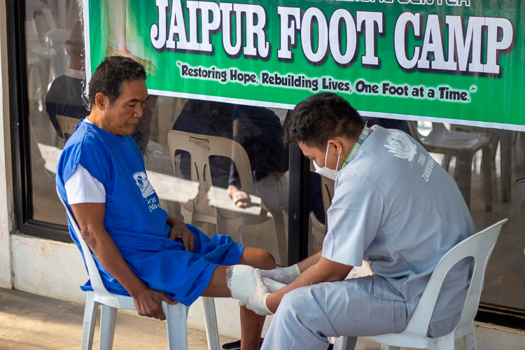 A prosthesis casting service was provided for incoming prosthesis recipients. 