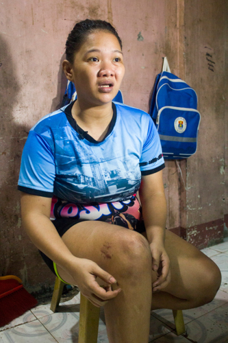 To repair her broken thighbone, Micholle Manila underwent an intramedullary nailing, the scars of which appear near her right knee. 【Photo by Matt Serrano】